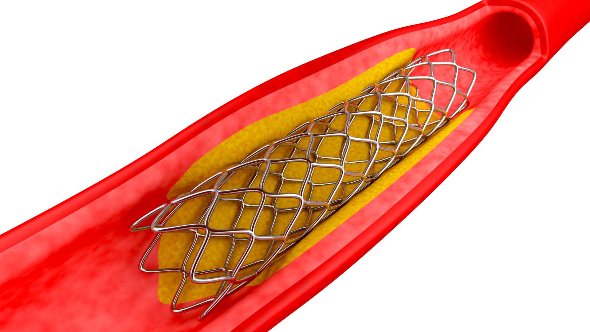 Stents Open Narrowed Arteries