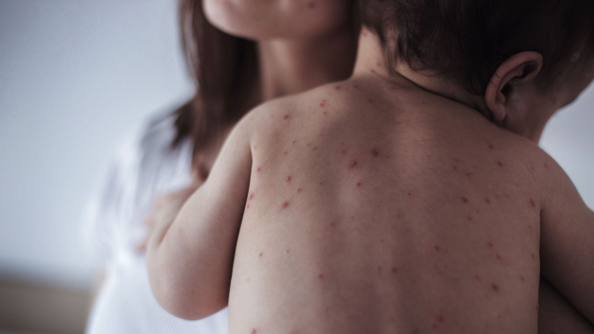 CDC Warns Of Pending Measles Outbreak In Children
